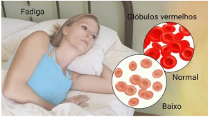 Woman experiencing fatigue due to iron deficiency anemia, illustrated with images of normal and low red blood cell levels. Relevant to ICD-10 code D50.9.